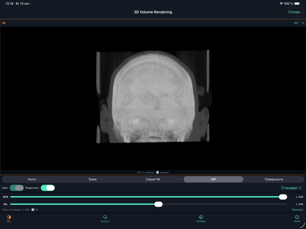 3D: MIP de todo el volumen